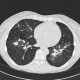 Wegener's granulomatosis, development in time, year five: CT - Computed tomography